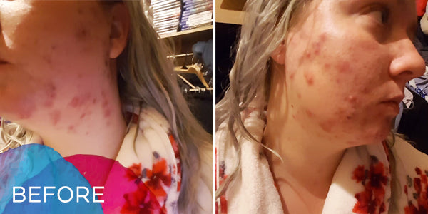 Simone Thomas Client success story - Sharelle's skin before Bioenergetics treatment