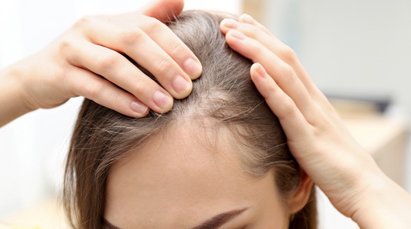 Close up image of a woman's scalp who is suffering from hair loss