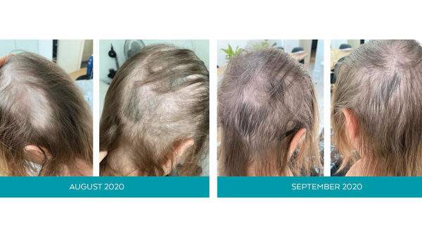 Before and after of hair loss after supplements