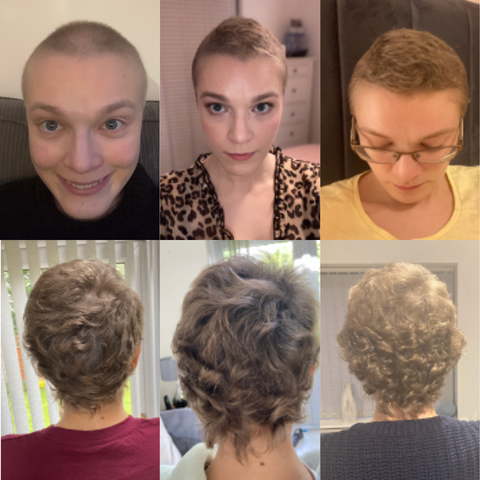 carolines-hair-loss-progress