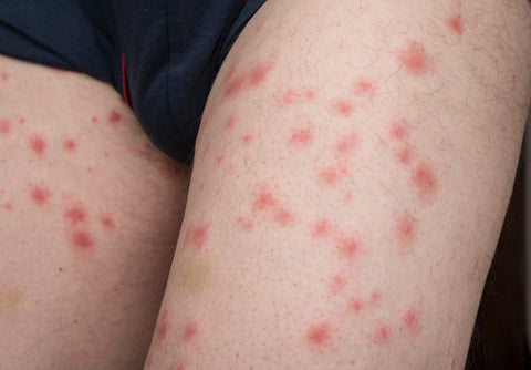 Photo of bed bug bites on human skin