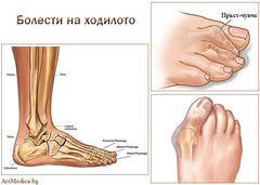 Болести на ходилото