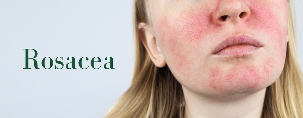 Rosacea Symptoms, Triggers, and Soothing Your Skin