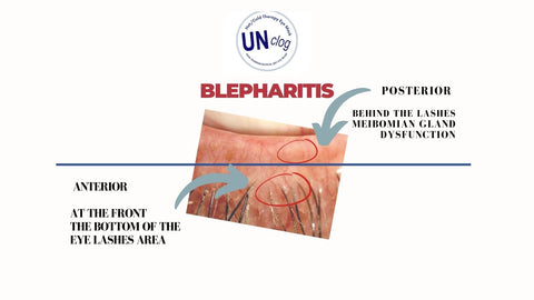 Blepharitis, in general, is just a term describing some sort of “inflammation,” or I like to explain it as the state of unhappiness in the eyelid environment.  With that in mind, when dealing with Blepharitis, it is a good idea to find out these few things:  Where in the eyelids are the unhappiness occur?  Is it the front of the eyelids (anterior) of the back/ closest to the eye (posterior)?
