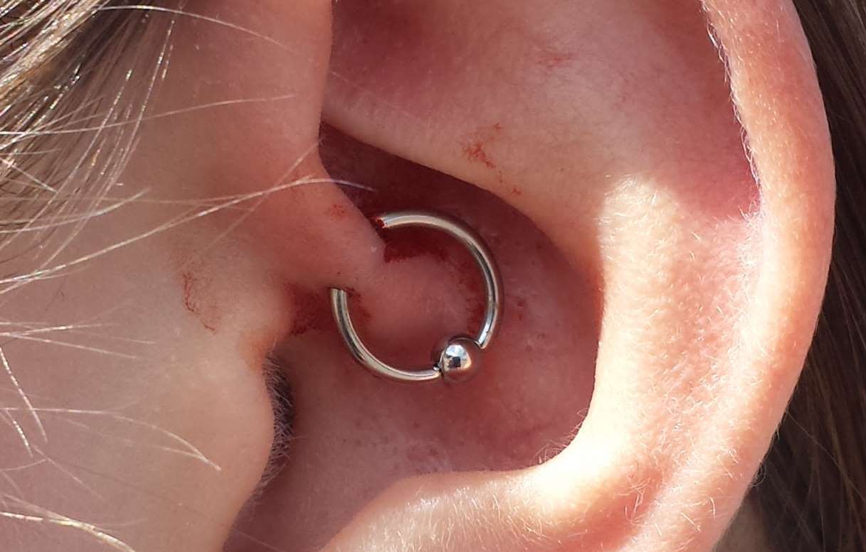 A new daith ear piercing showing dried blood on the ear of a female model.