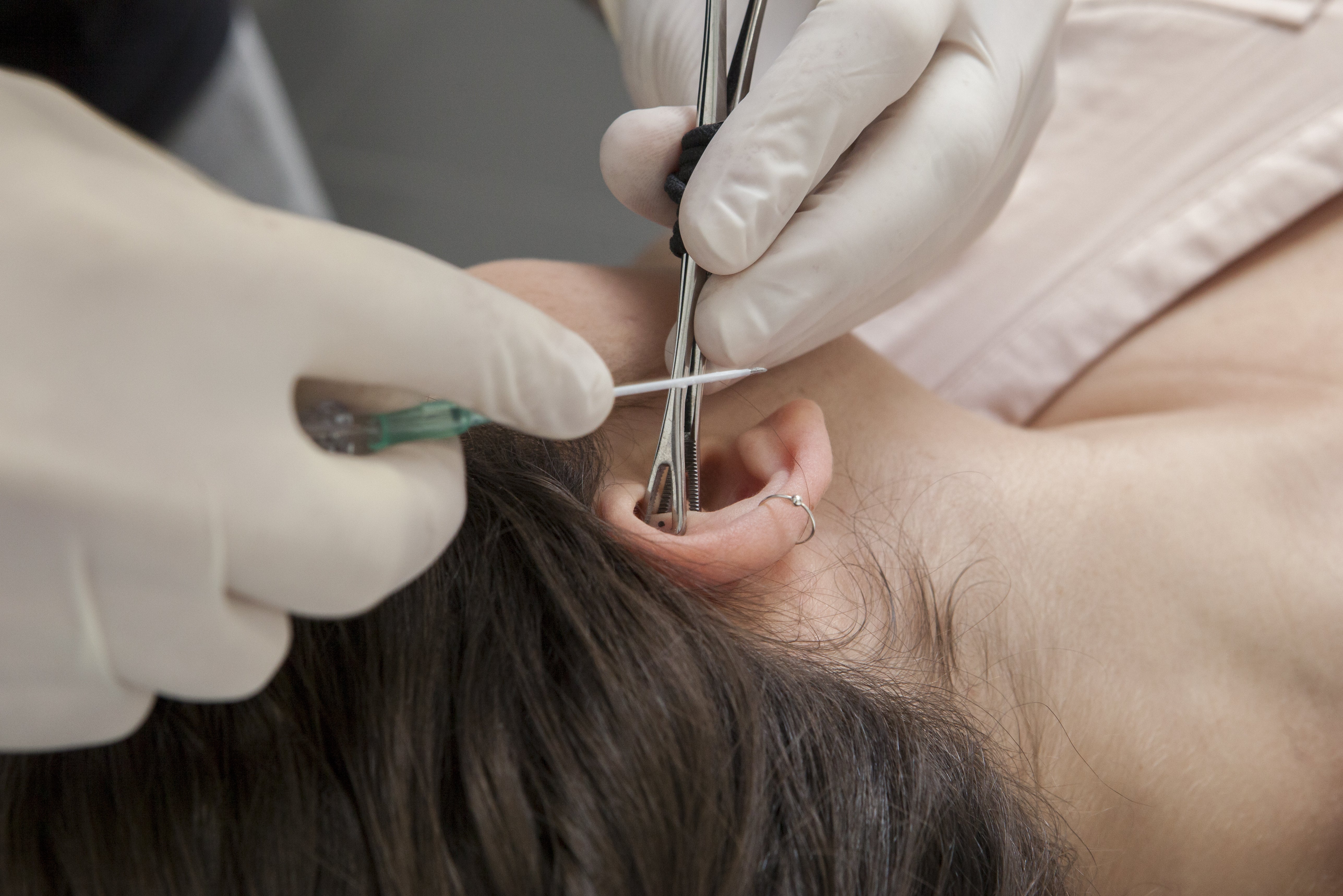 The rook piercing procedure showing a females ear in clamps with a pair of gloved hands holding a needle waiting to be shoved through the cartilage.