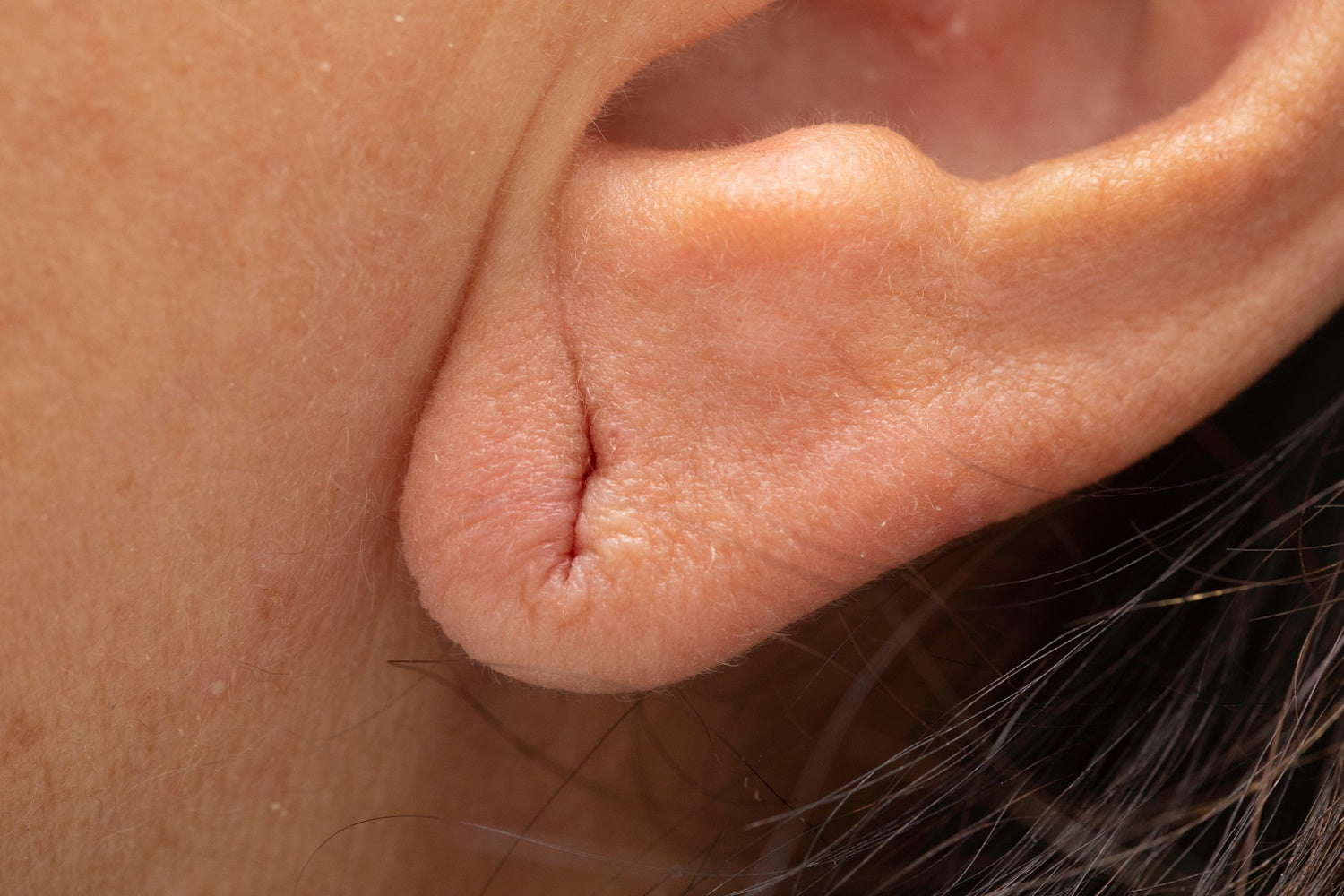 What an earlobe piercing looks like after it has been stretched and then the jewelry removed and it shrank.