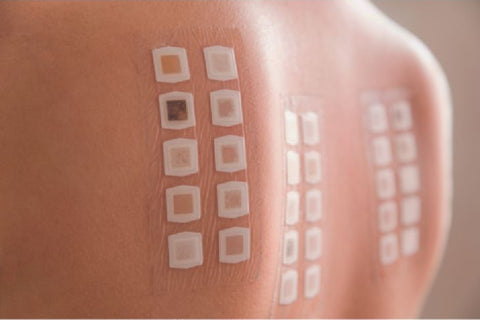 Allergy patch testing to determine your allergens