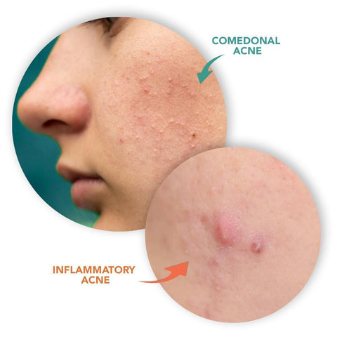 example of acne types