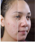 Image of Teen Before & After Acne Wipeout