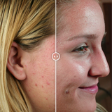 Image 3 Teenage Acne Before & After Treatment