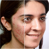 Image 2 of Teen Before & After Acne Wipeout