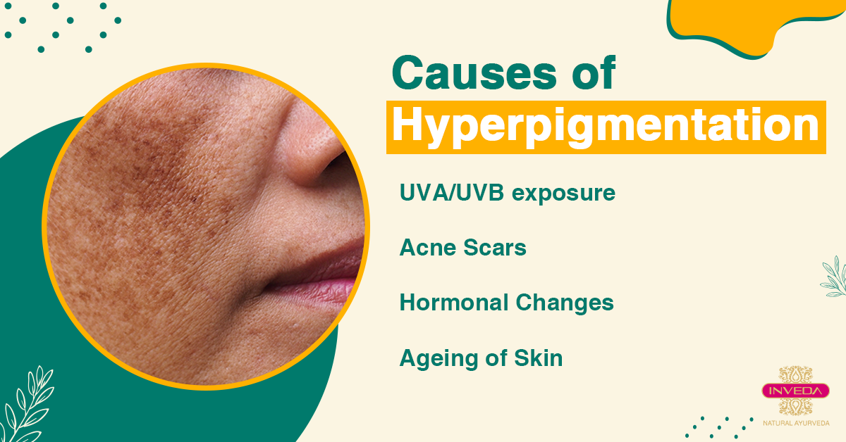 Know How To Get Rid Of Hyperpigmentation With Easy Tips And Hacks