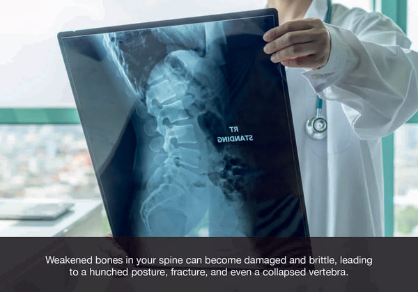 Weakened bones in your spine can become damaged and brittle, leading  to a hunched posture, fracture, and even a collapsed vertebra.