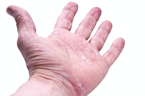 hand flaky skin