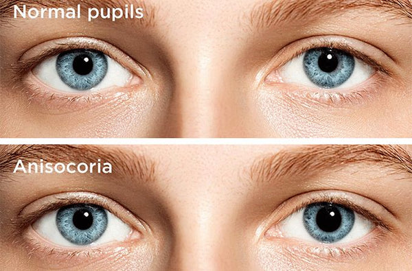 Anisocoria pupil eyes