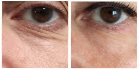 filler under eye before and after