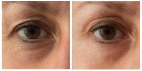 under eye filler before and after