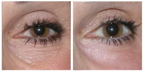 before and after under eye bags filler