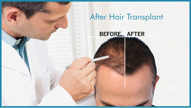 After hair transplant, HairCubed The only product on the market that thickens your actual hair. Waterproof!