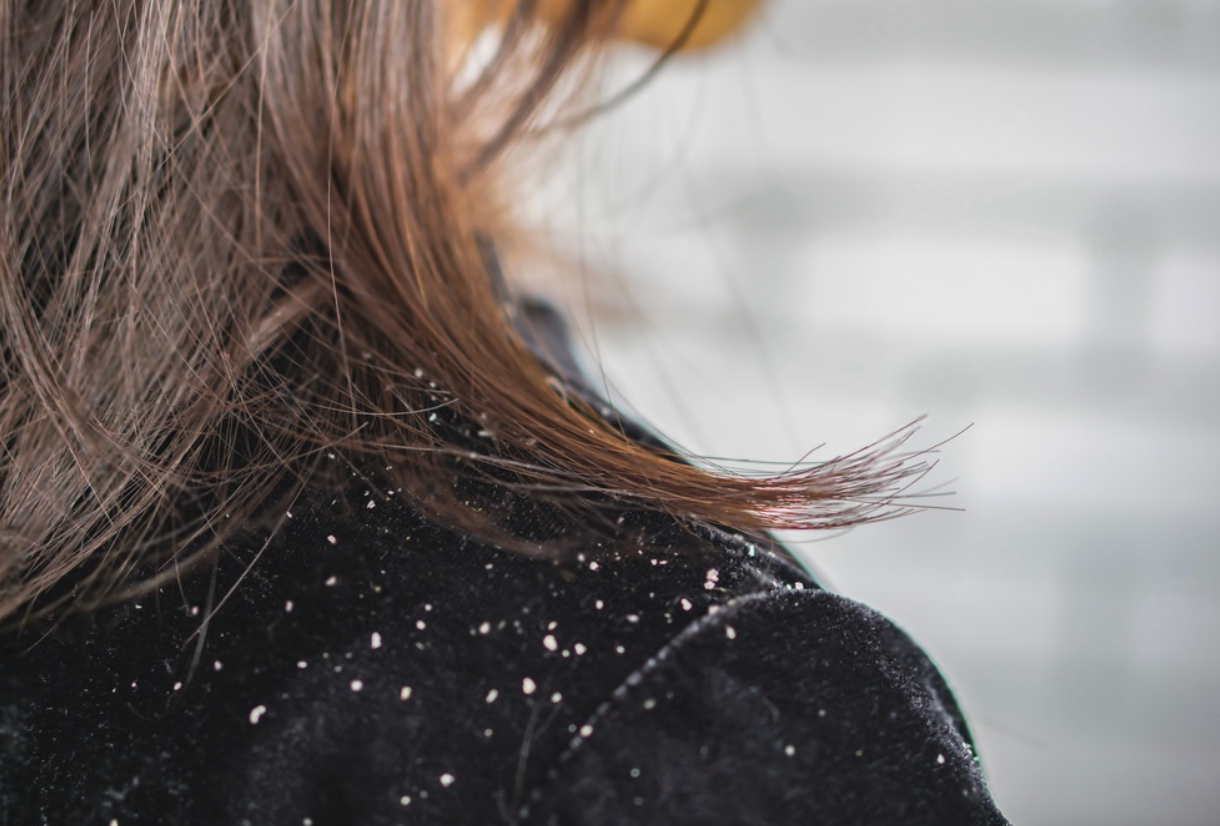 Conquering Dandruff to Improve Hair Growth