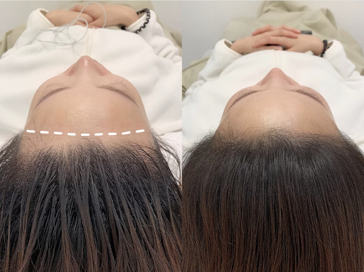 Can Scalp Micropigmentation Conceal Bald Spots And Thinning Hair?