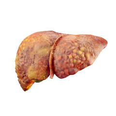 Alcoholic Liver Disease