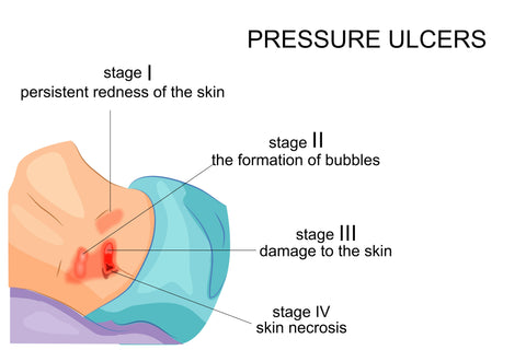 Pressure Ulcer Stages