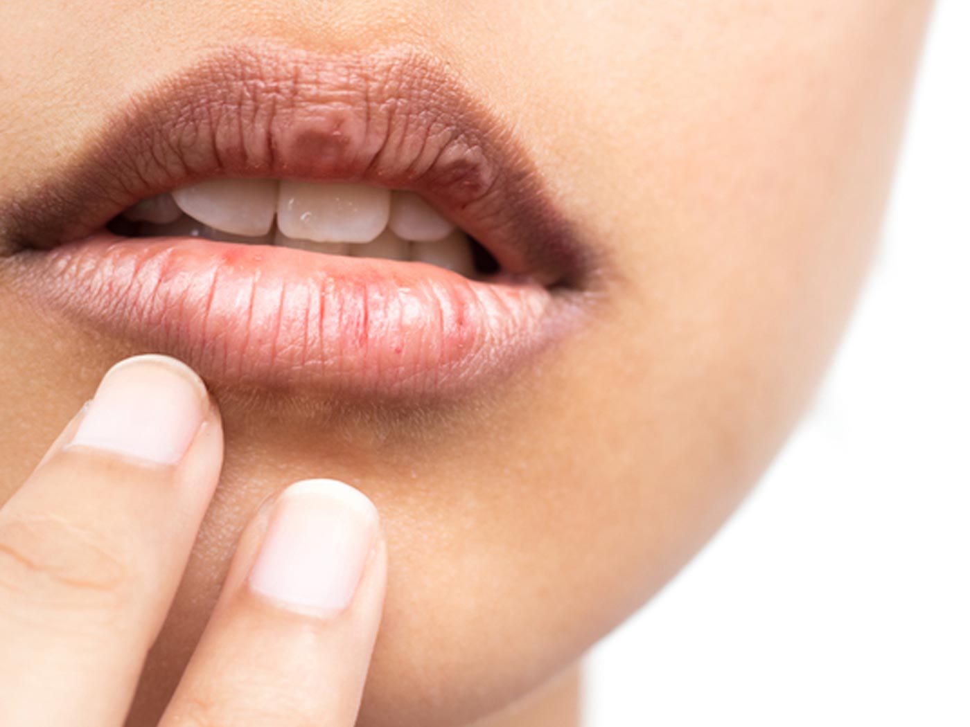 Chapped Lips Causes And Treatment Of Chapped Lips Pure Sense