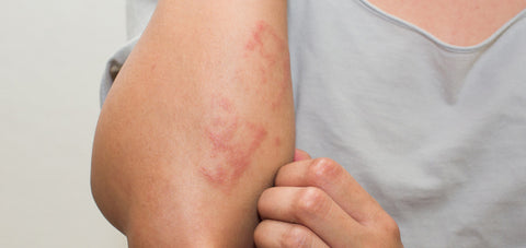 Heat rashes on skin