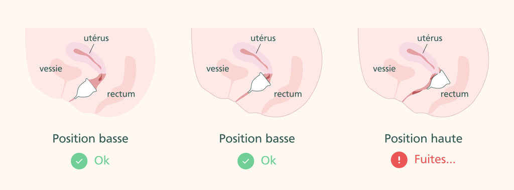 Positionnement de la coupe menstruelle par rapport à l'utérus en trois schémas 