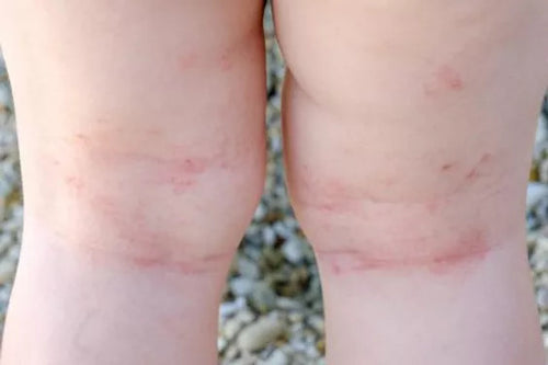 Child with Eczema on knees