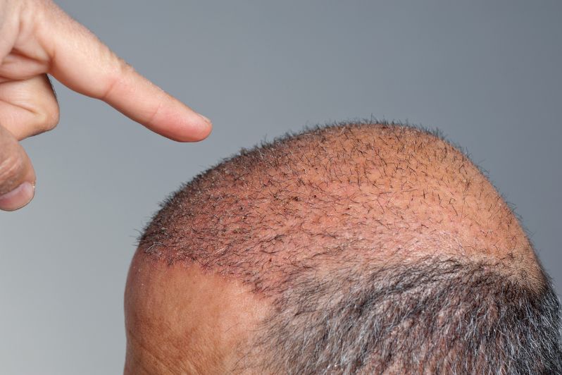 After hair transplant.jpg__PID:0a8f0f62-eff9-4cff-aab8-31637bf5ecd4