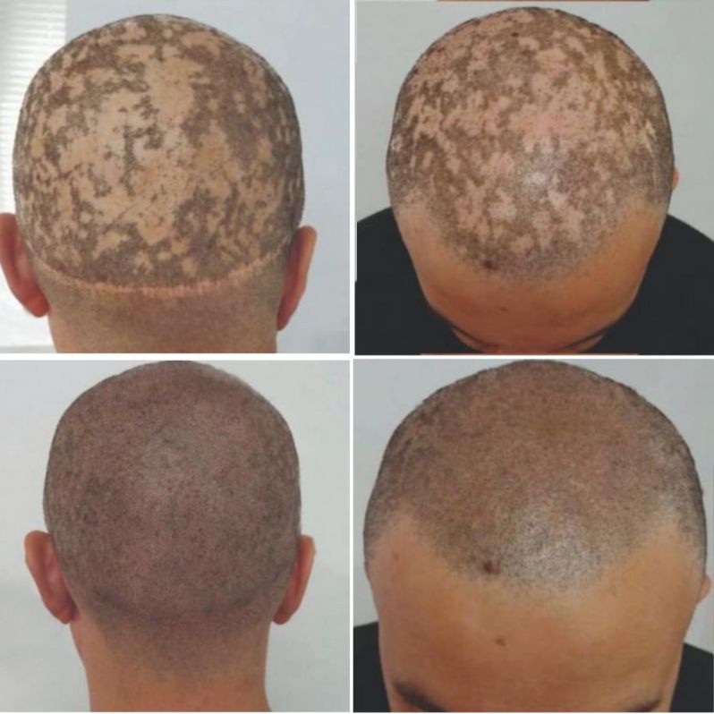 Alopecia Areata & FUT Scar - SMP Results