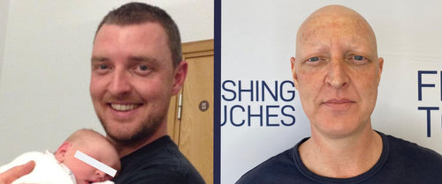 Before and After Alopecia Universalis Hair Loss