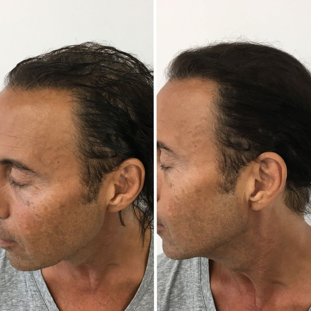 Male Hair Thinning - Scalp Micropigmentation Results 