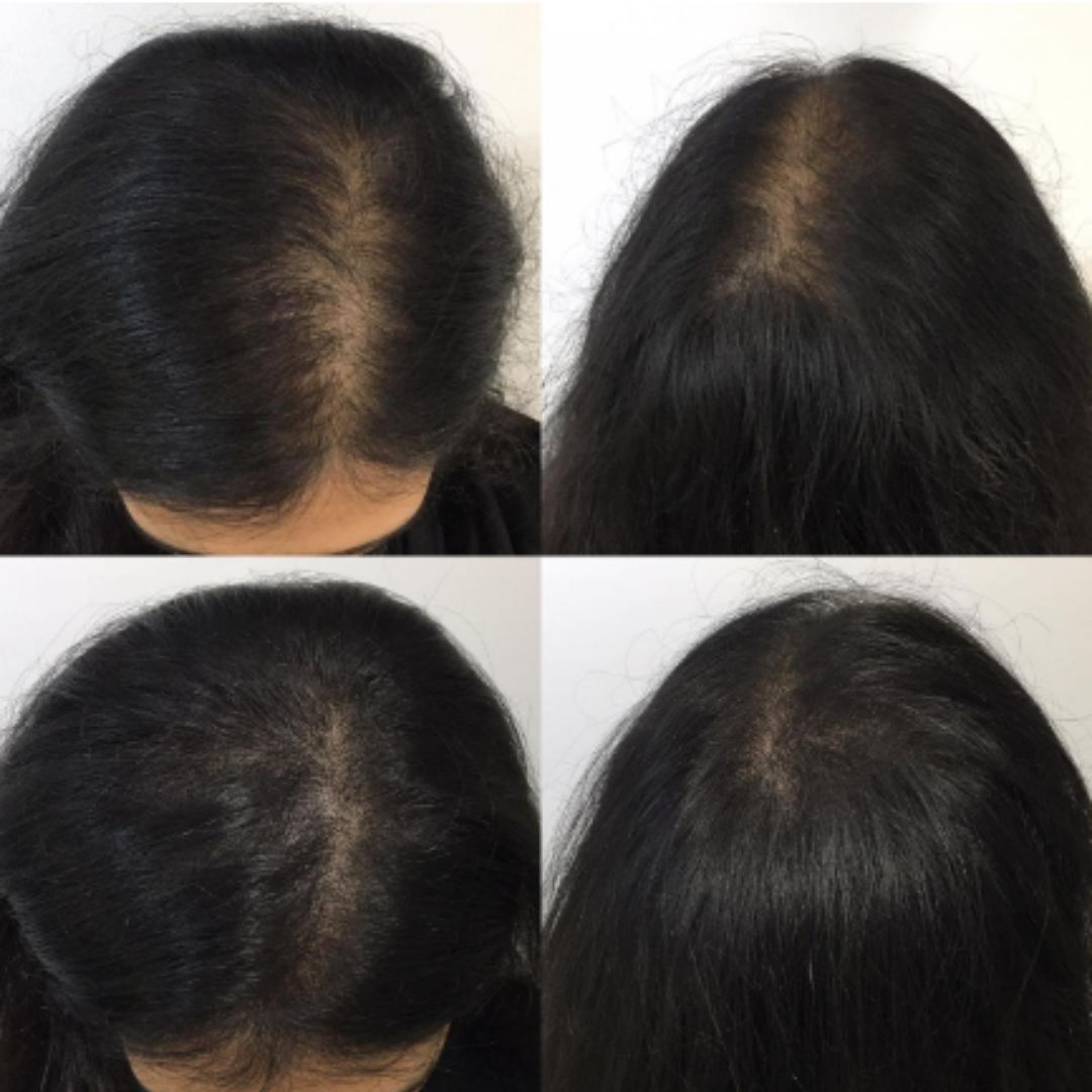 Female Scalp Micropigmentation Density Treatment Results