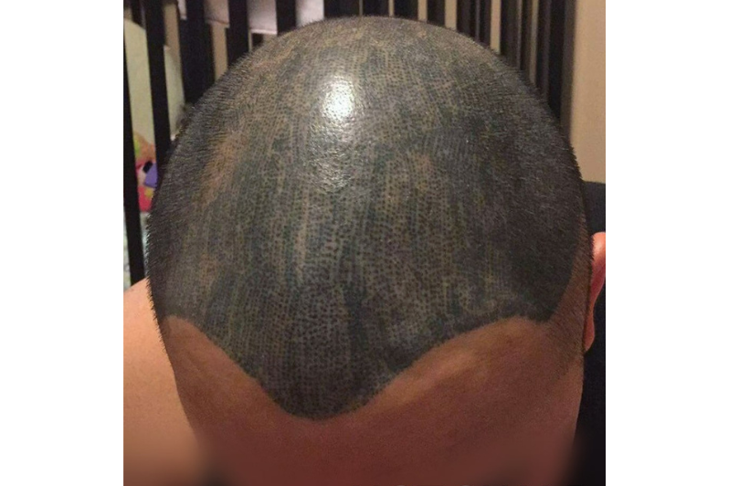 Example Of Botched Hair Tattoo.png__PID:465eef30-8d27-40bb-b0f3-f574702b7464