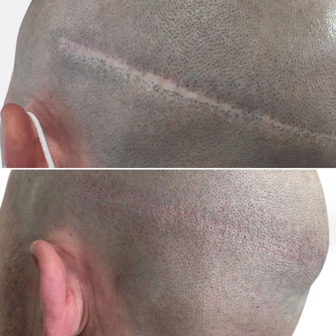 FUT Scar Camouflage with Scalp Micropigmentation Results