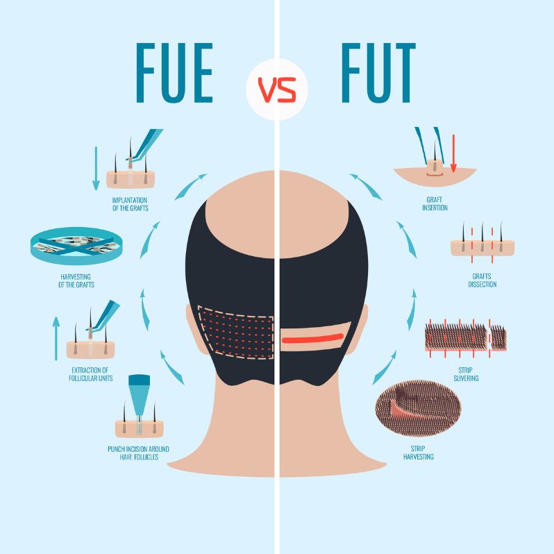 FUT vs FUT Hair Transplant