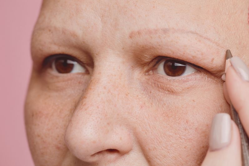 Lady with eyebrow hair loss due to alopecia