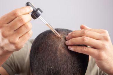 Man applying Minoxidil (1).jpg__PID:a89a71c2-b707-41c6-ab46-7fb7e06a0994