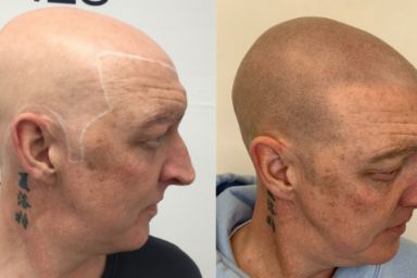 Paul's Eyebrow & Scalp Micropigmentation Results Case Study