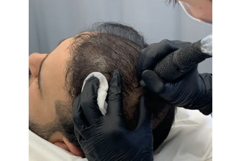 SMP Treatment After Hair Transplant