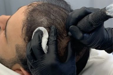 SMP after hair transplant procedure