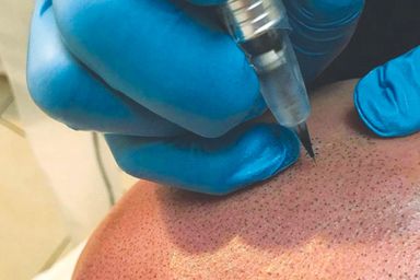 Scalp Micropigmentation close up of treatment