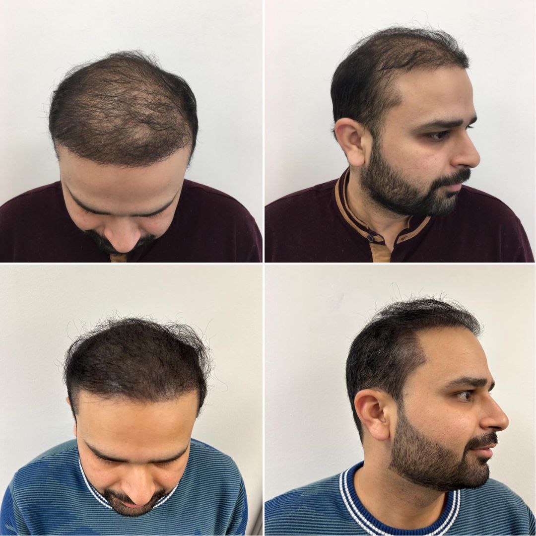 Scalp Micropigmentation After Hair Transplant 2 years