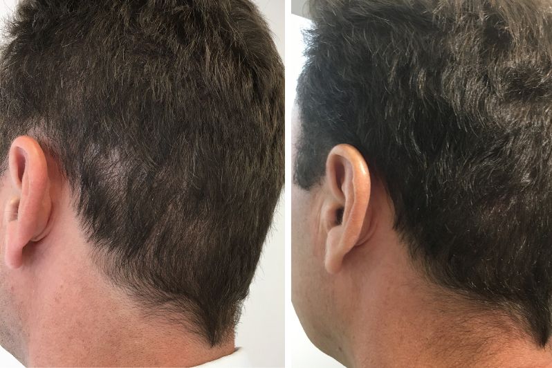Scalp Micropigmentation For FUE Scars Results