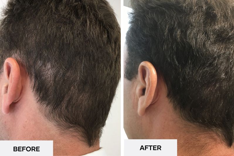 Scalp Micropigmentation For FUE Scars Results