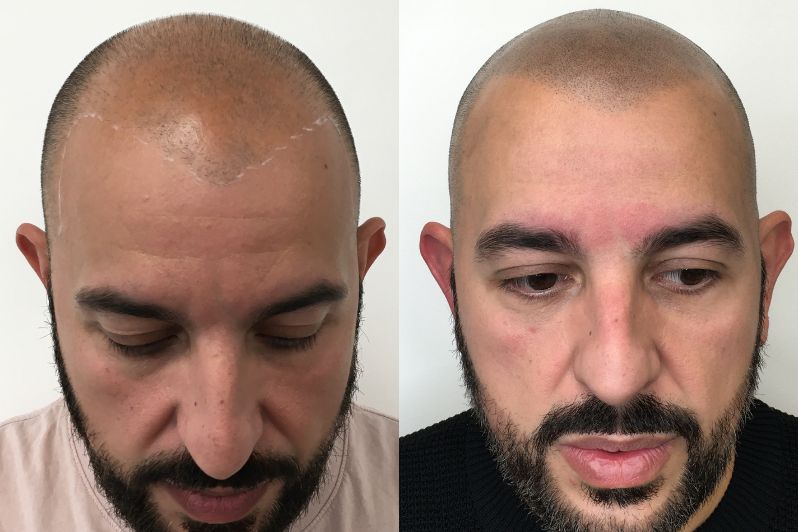 Scalp Micropigmentation Results.jpg__PID:eeaf6b94-6900-405a-a633-489166645ed3